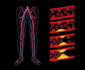 Peripheral artery disease doctor medical solutions