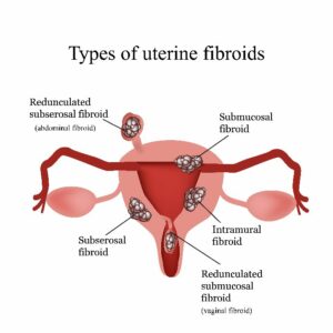Fibroid Treatment Options Uterine Womens Health