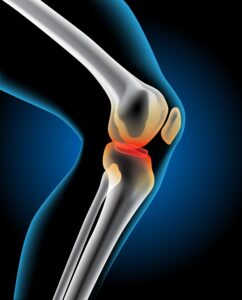 Joint Pain Treatment Knee Genicular Artery Embolization