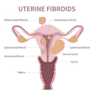 Uterine Fibroids Treatment
